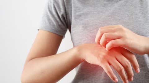 Why do mosquito bites itch so much? - Mosquizen